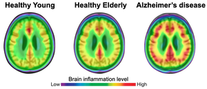 The degree of neuroinflammation (red) is more pronounced in brains of patients with Alzheimer’s disease than in healthy individuals.