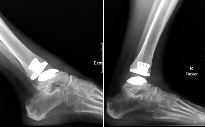 Total Ankle Arthroplasty Offers Patients Greater Range of Motion and Less Pain