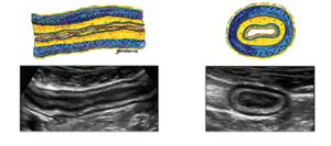 Longitudinal and Cross-section Views of Bowel