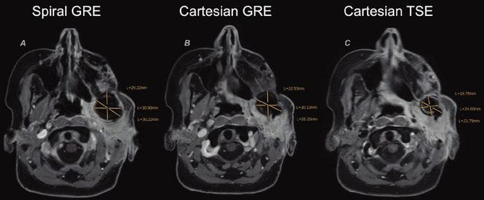 56-Year-Old Woman Who Underwent MRI of Head and Neck