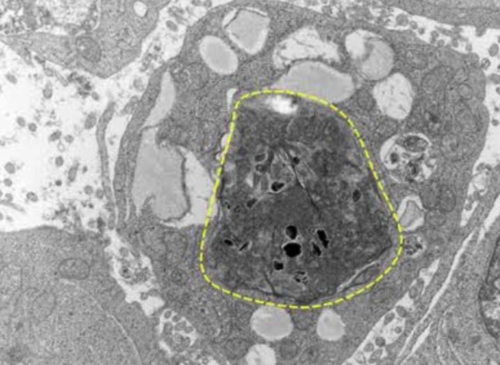 Melanoma Tumor Cells