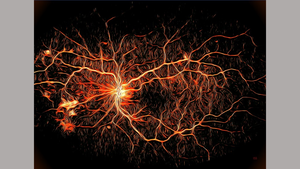 Artistic rendition of diabetic eye disease