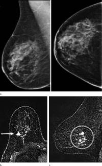 Digital Breast Tomosynthesis Improves Invasive Cancer Detection (2 of 2)