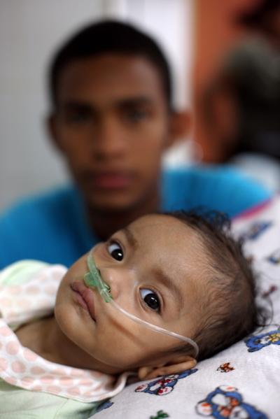 Child Affected by Pneumococcal Disease