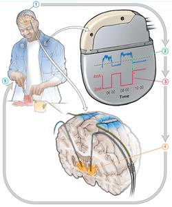 Adaptive DBS system for Parkinson's Disease