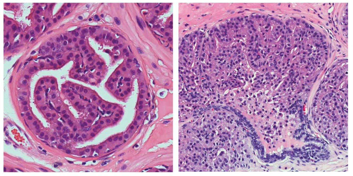 Loss of Importin-11 Causes Prostate Neoplasias