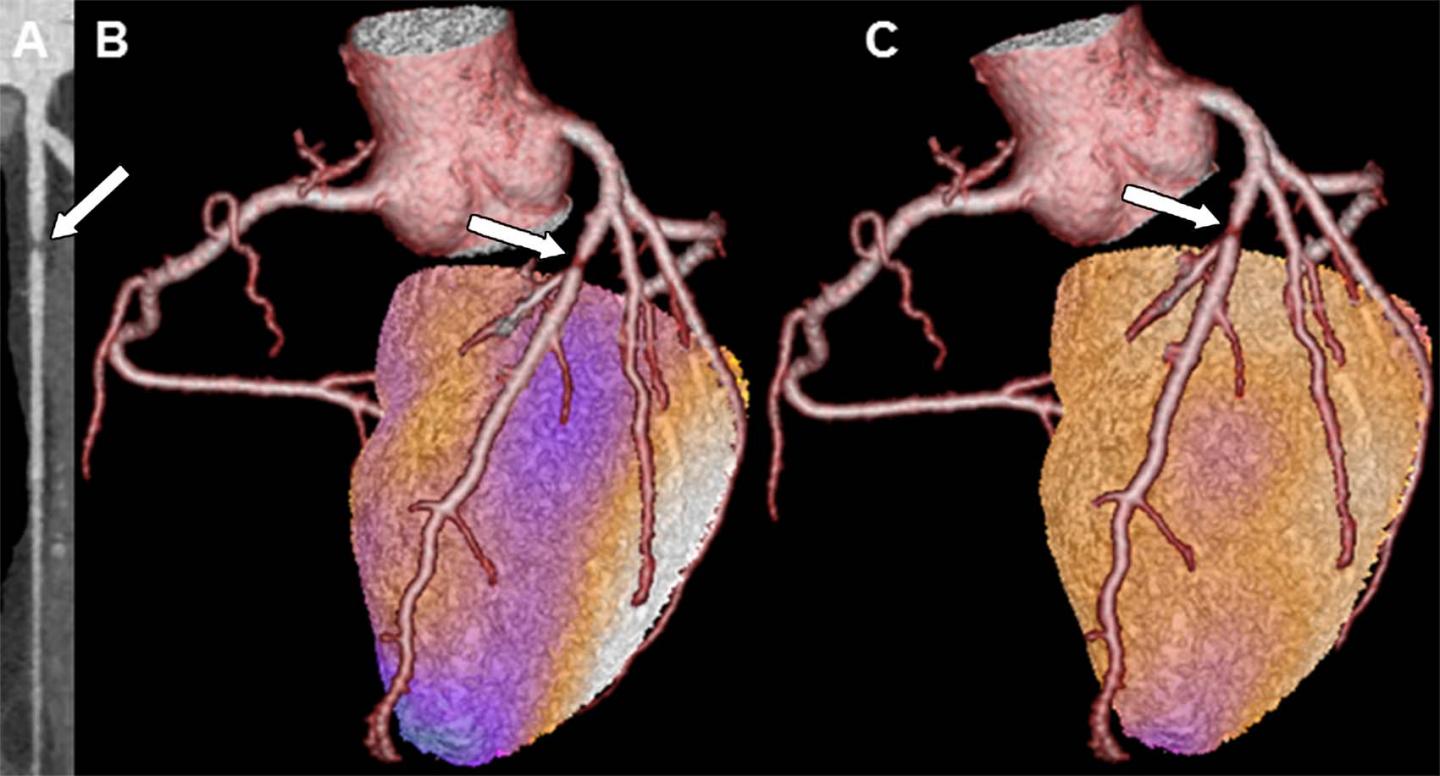 Images in a Patient with a Matched Cardiac Hybrid Imaging Finding (Arrows)