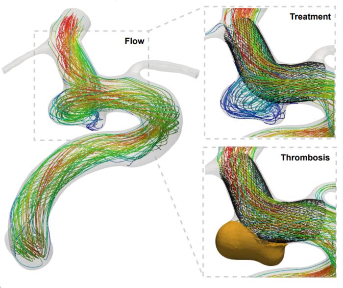 Vascular flow modelling exemplar; intracranial aneurysm flow, treatment and thrombosis