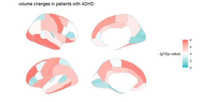 Researchers Identify Brain Markers of ADHD in Children
