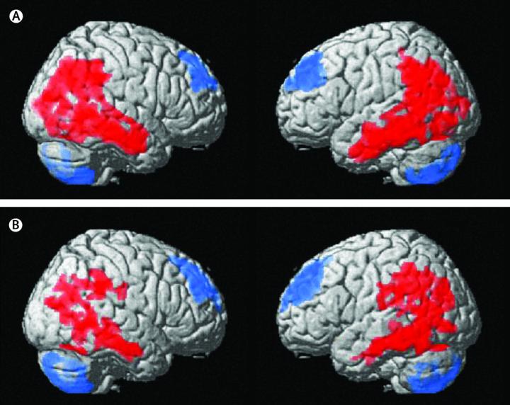 Brain Activity Differences