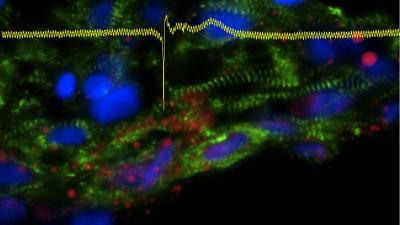 ARVD/C Disease in a Dish
