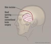 Conventional Brain Surgery