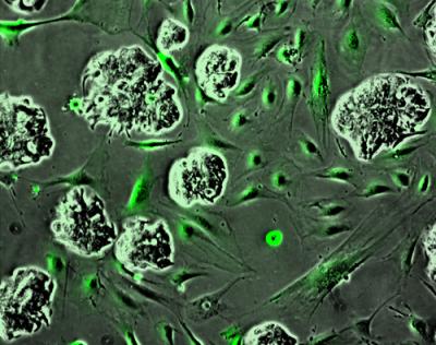 Colon Cancer Cells and Stroma