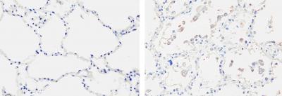 SARS Virus Promotes Fibrosis in Lung Cells