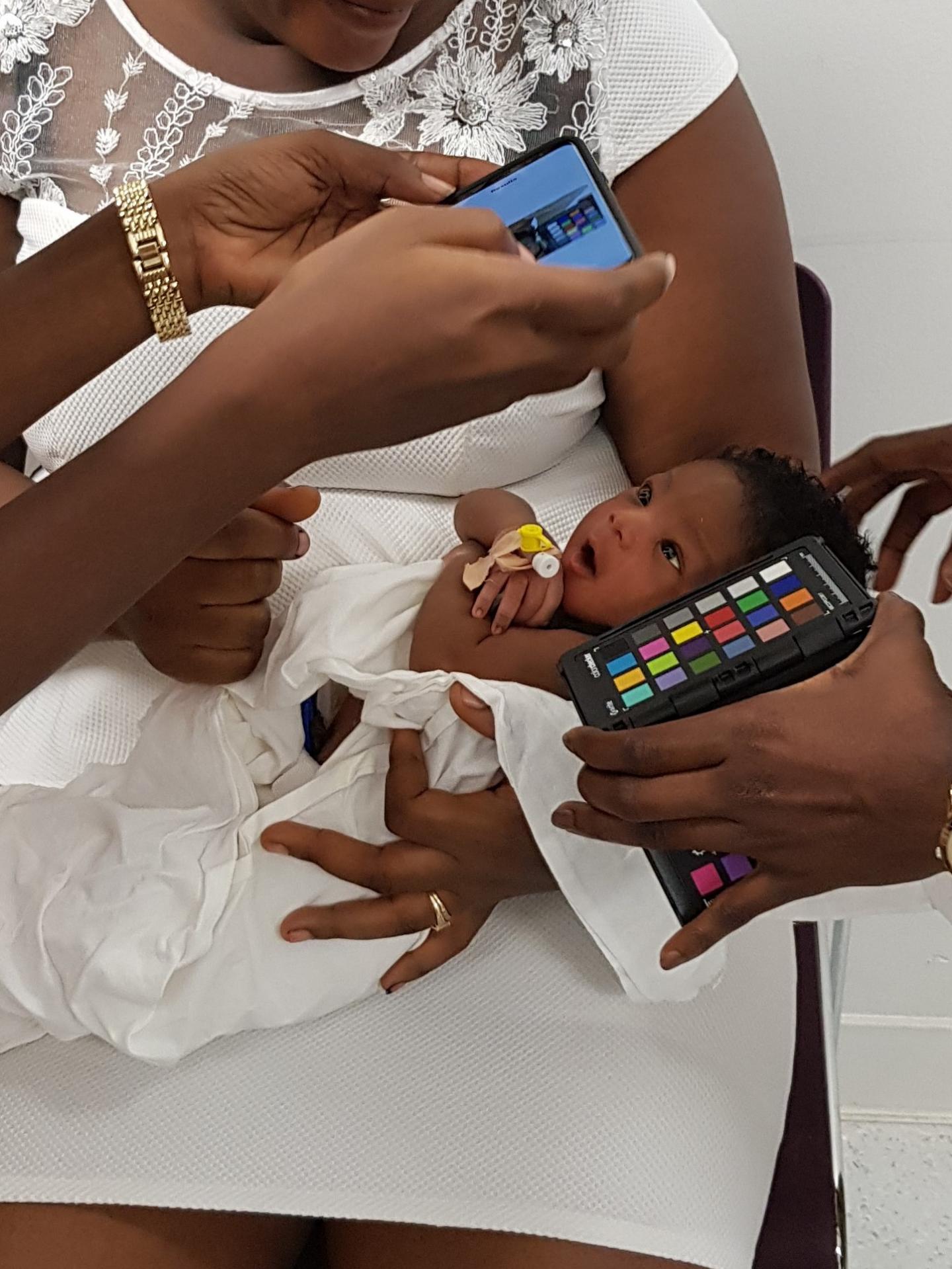 Smartphone-Based Screening of Jaundice