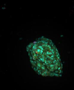 Organoid model of a tumor.