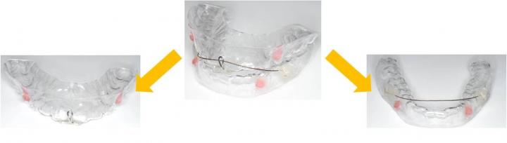 The Oral Appliance (Mandibular Advancement Appliance)