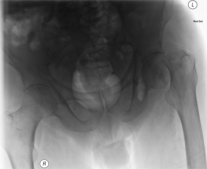 Hip fracture radiograph - anonymised
