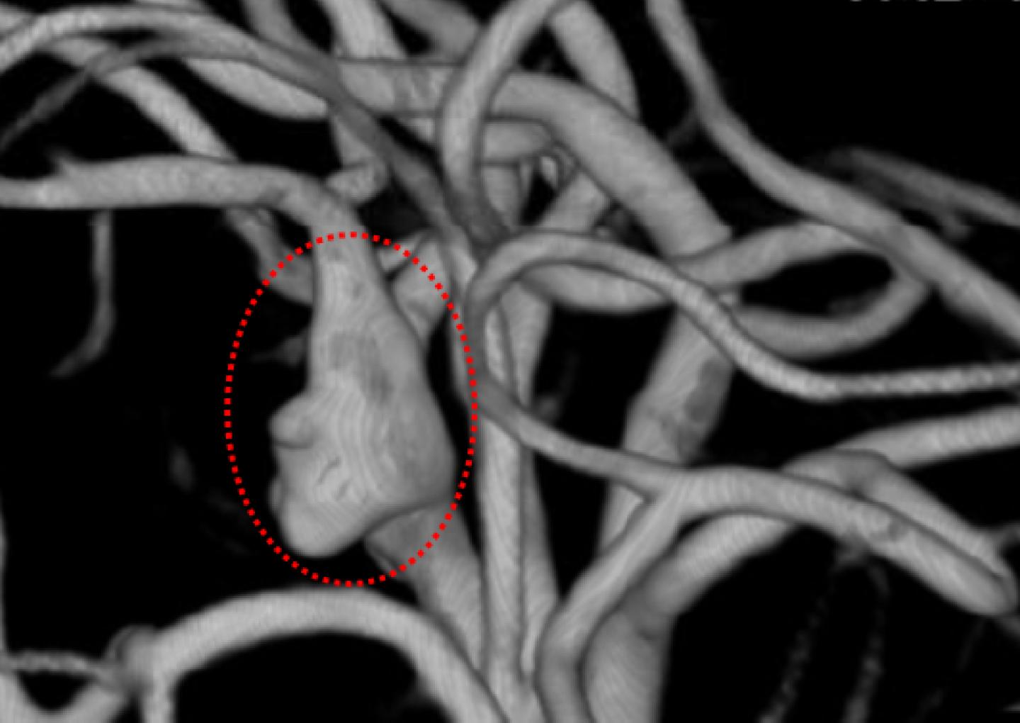 Blood Vessel Showing An Aneurysm Circled in Redblood Vessel Showing An Aneurysm Circled in Red