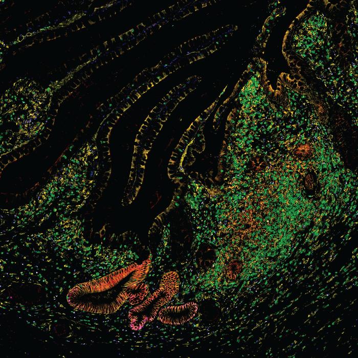 Human Intestinal tract in IBD