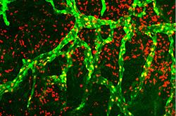 Overgrowth of Lymphatic Vessels