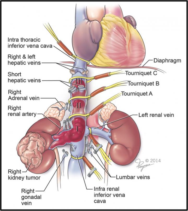 First Reports of Robotic Surgery for Advanced Vena Cava Tumor Thrombus Due to Kidney Cancer