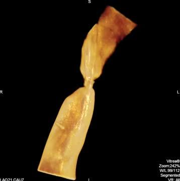 Computational and Animal Modeling Guides Clinical Testing of Tissue-Engineered Vascular Grafts (4 of 7)