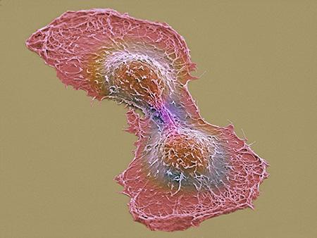 Electron Micrograph of Cancer Cells