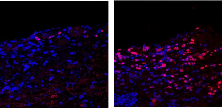 HSV Reactivation