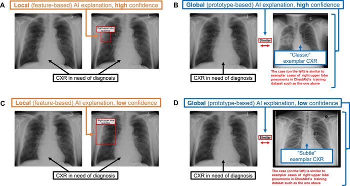 Chest radiograph examples of local AI explanations and global AI explanations from a simulated AI tool