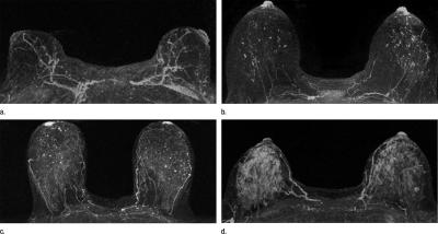 Examples of Varying Amounts of Background Parenchymal Enhancement