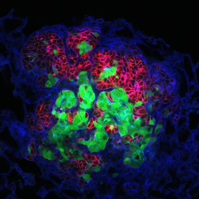 A Breast Cancer Metastasis in the Lungs