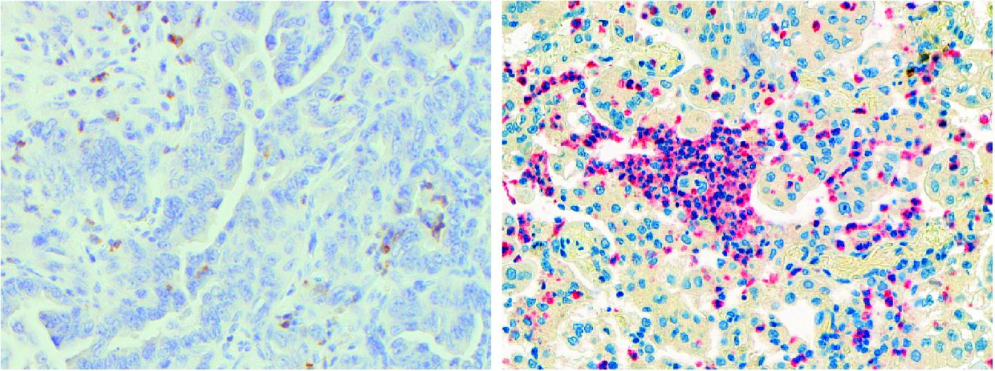Neutrophils Inside Lung Adenocarcinoma Tumors