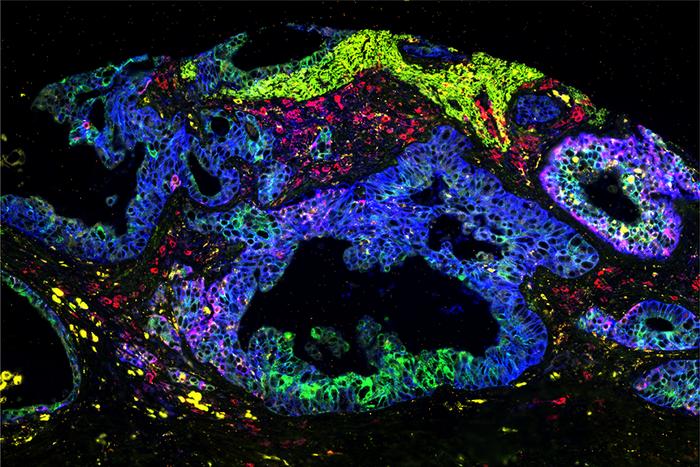 Researchers Develop Insights into KRAS Mutations in Pancreatic Cancers