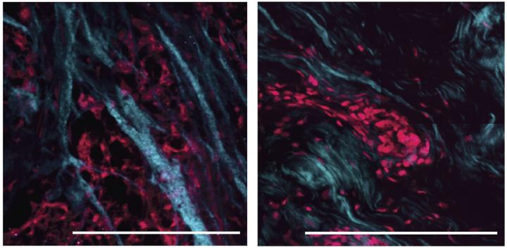 The breast tumor environment is remodeled after therapy