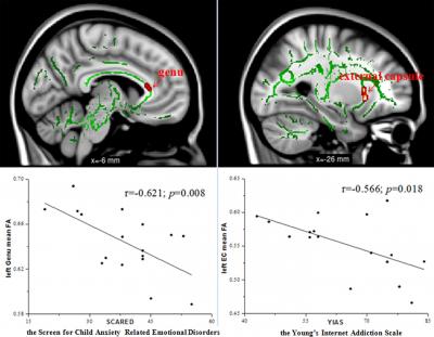 Internet Addiction Disorder Characterized by Abnormal White Matter Integrity