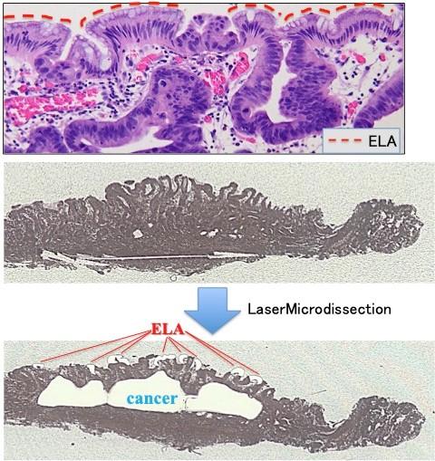 Extraction Methods for Cancerous Tissue, Normal Tissue, and ELA