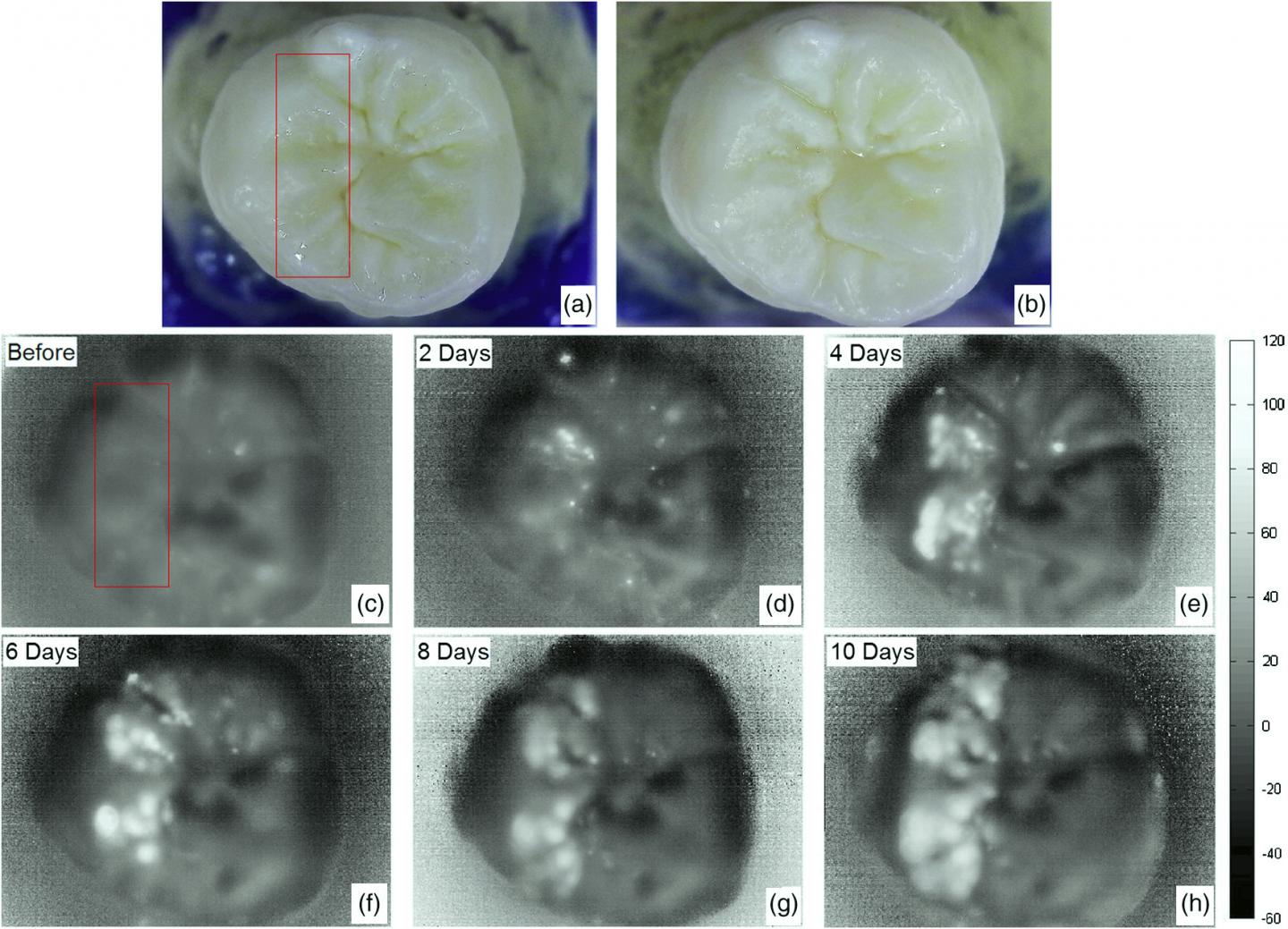 York University Researches New Imaging Tool for Tooth Decay Detection