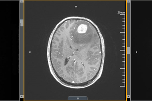 Boosting T cells improves survival in mice with glioblastoma