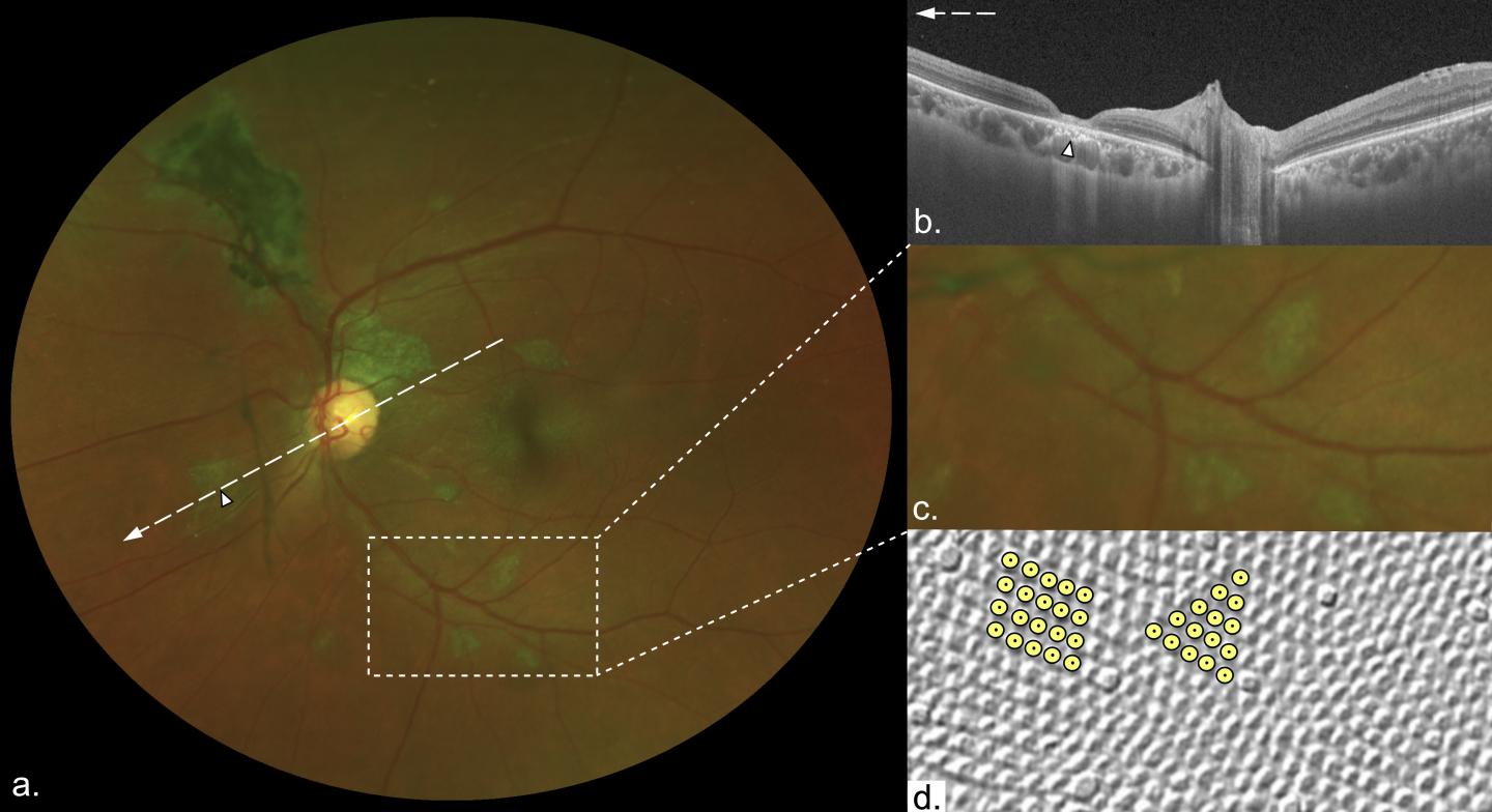 Characteristic Features of Lesions
