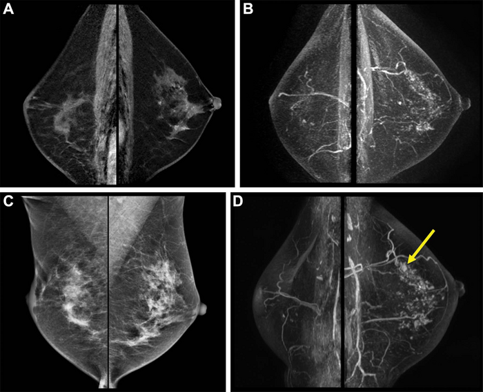 Breast MRI Illuminates Risk of Second Breast Cancer