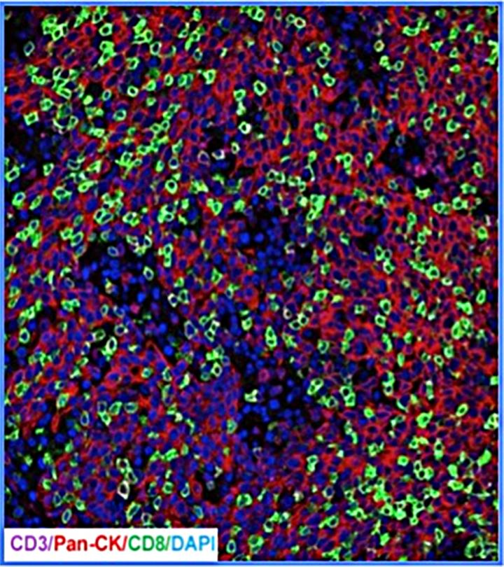 Head and Neck Cancer under the Microscope