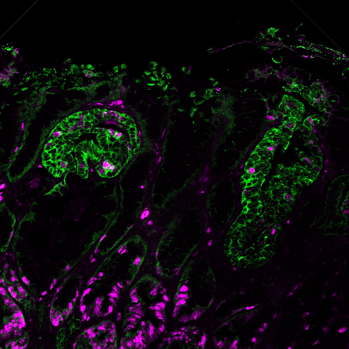Gastric tumour containing Lgr5-expressing stem-like cells