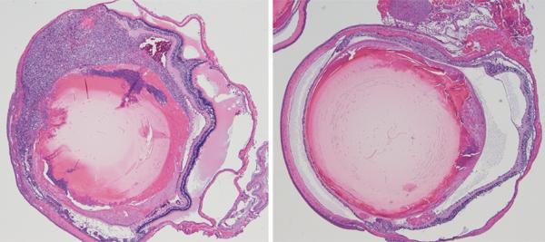 Drug Treatment Slows Eye Cancer