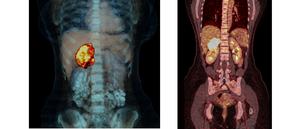 Adrenocortical carcinoma