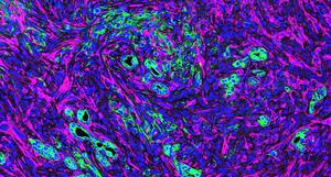 Pancreatic cancer fibroblasts