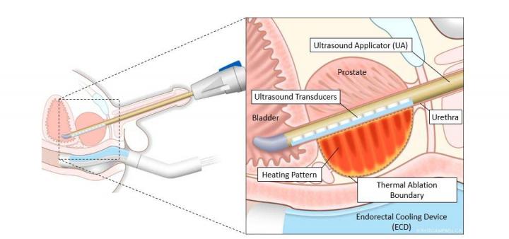 Novel MRI-Guided Ultrasound Treatment Destroys Prostate Cancer