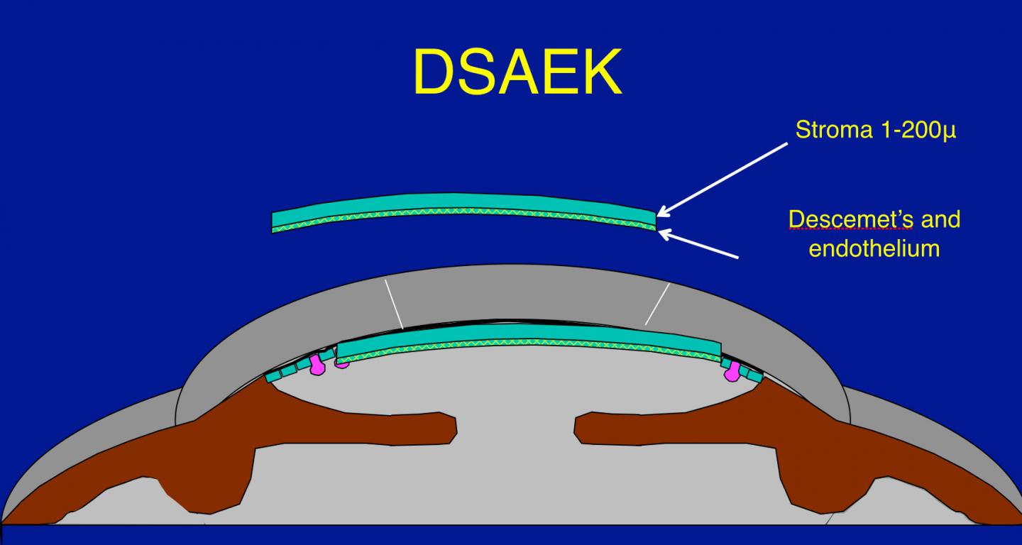 DSAEK Corneal Transplantation [IMAGE] EurekAlert! Science News Releases