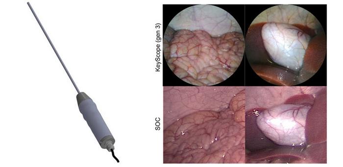 Low-cost laparoscope, the KeyScope, enables high resolution surgical imaging with a wide field of view, color accuracy, and low distortion, resulting in comparable images to a standard laparoscopic device.