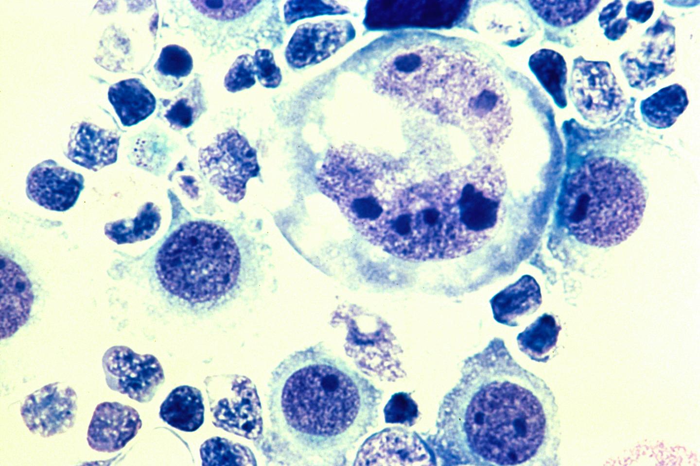 Human Lymphoma Tumor Cells